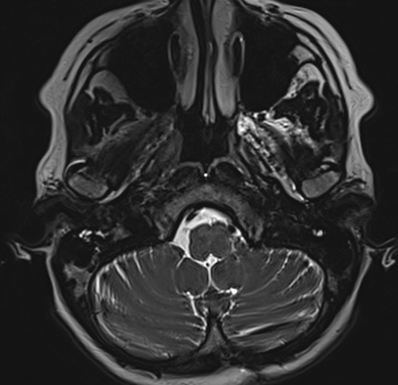 Meningiom de foramen magnum