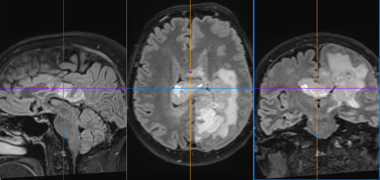 Tumorile de lob parietal - semne și simptome