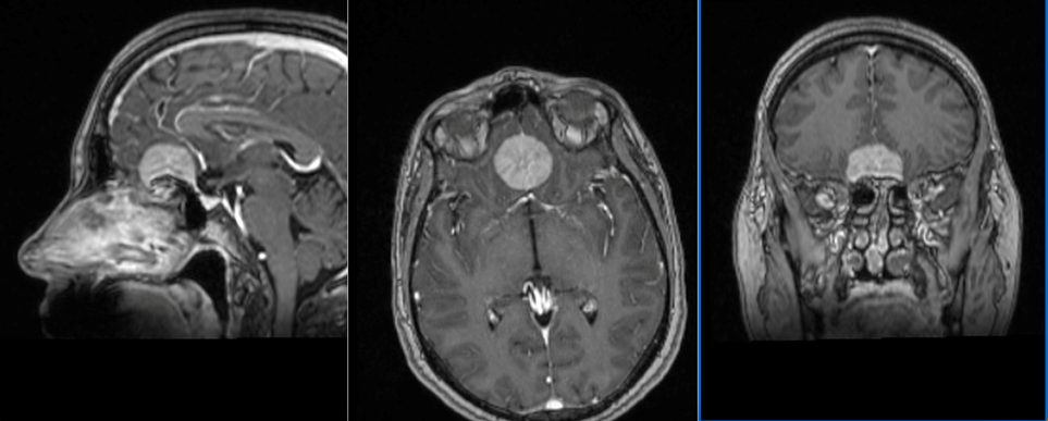Tumoră de bază de craniu – meningiom olfactiv