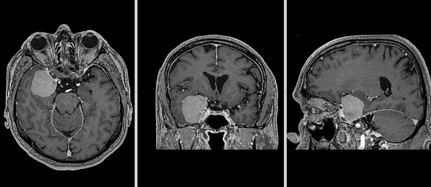 Meningiom de aripă de sfenoid