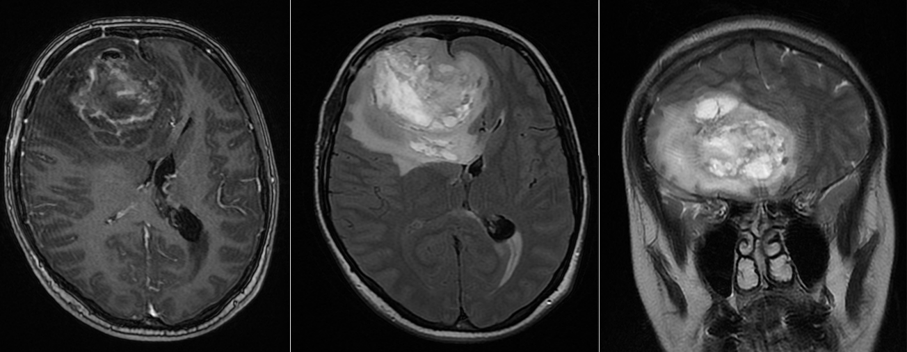 Glioblastom hemoragic asociat sarcinii – 10 ani fără progresie