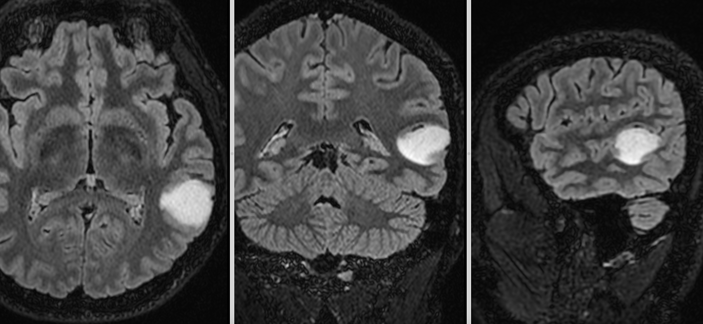 Awake surgery pentru gliom de grad mic temporal stâng