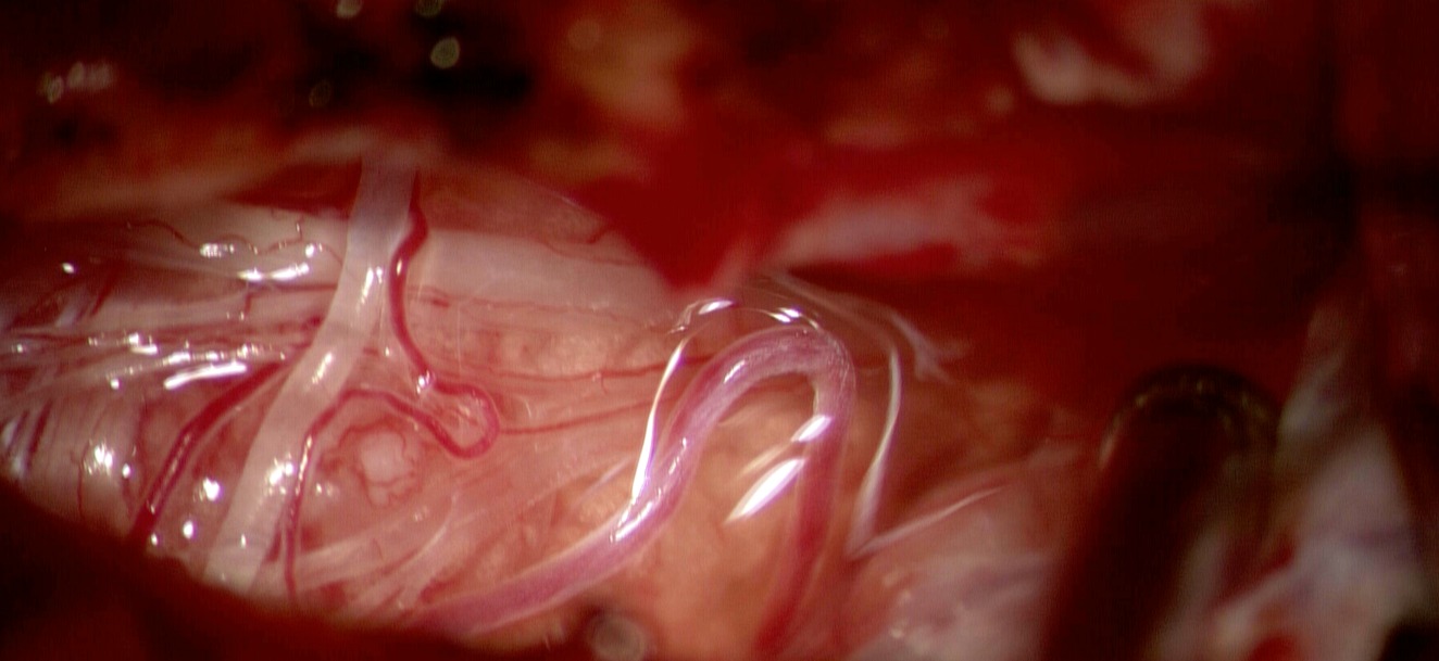 Meningiom de foramen magnum